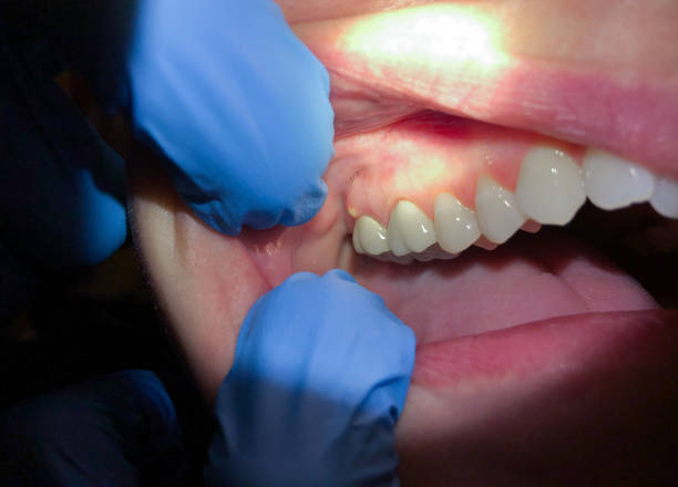 Best Emergency Dental Care for Abscessed Tooth in Pen Argyl, PA